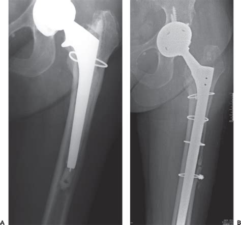 Use Of The Extended Trochanteric Osteotomy In Revision Total Hip