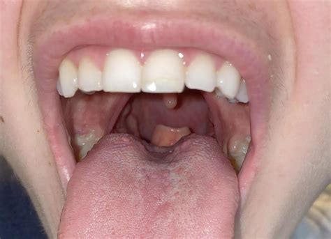 Visible Epiglottis Rmedicaladvice