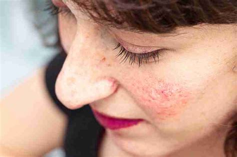 The Menopause And Acne Rosacea How Are They Linked Organic Apoteke