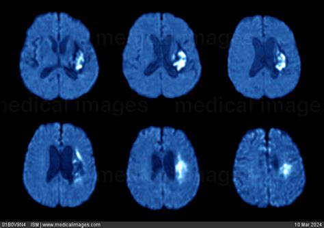 Stock Image Mri Of The Brain Contiguous Axial Sections Showing A