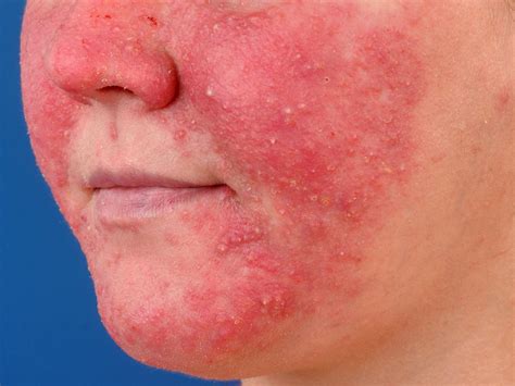 What Is Rosacea Pictures Photos