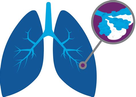Genentech Understanding Idiopathic Pulmonary Fibrosis