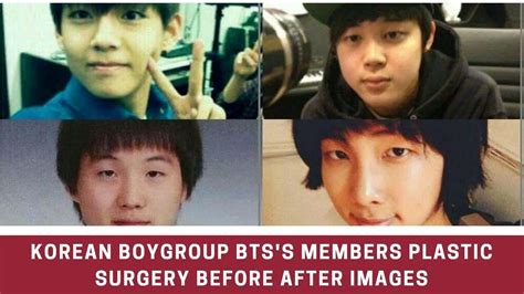 Bts V Plastic Surgery Before And After
