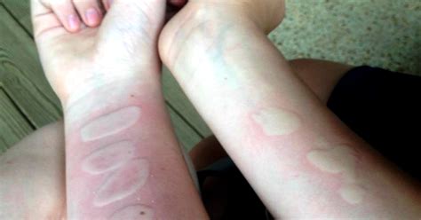 Attention Parents The Salt And Ice Challenge Can Actually Burn Your