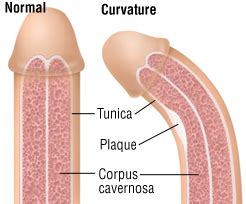 Good emotional health also means not suffering guilt or shame for our masculinity. Curvature of the Penis (Peyronie's Disease) - Harvard Health