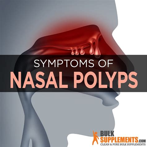 Nasal Polyps Symptoms Causes And Treatment By James Denlinger Medium