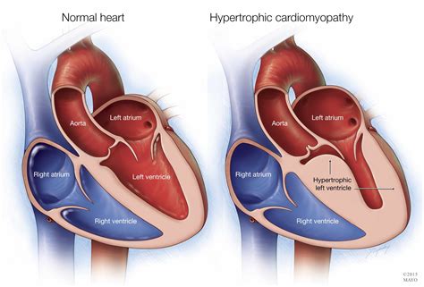 Miocardiopatía Hipertrófica Sintomas diagnostico y tratamiento