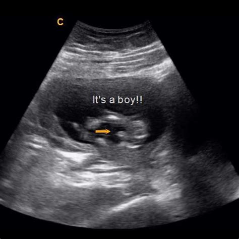 Early Gender Boys 14 Weeks 3d 4d 5d Hd Ultrasound Michigan