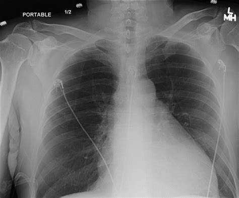 Chest X Ray Pa View Showing Cardiomegaly With Left Ve