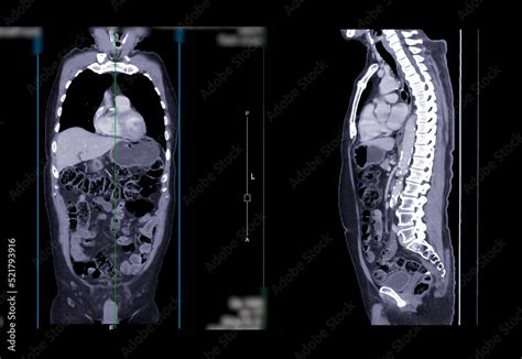 Ct Scan Of Chest And Abdomen Coronal And Sagittal View Stock 写真