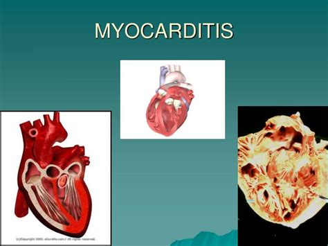Myocarditis can affect your heart muscle and your heart's electrical system, reducing your heart's ability to pump and causing rapid or abnormal heart. PPT - INFLAMMATORY CONDITIONS OF HEART PowerPoint Presentation - ID:1433221
