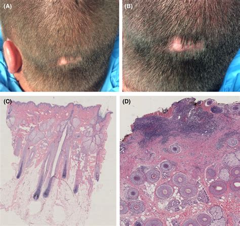 Single Dome‐shaped Alopecic Skin‐colored Nodule Of The Occiput In A