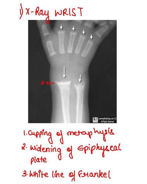 Rickets X Ray Wrist Medizzy