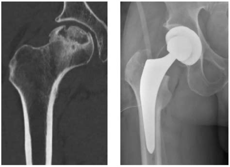 Avascular Necrosis Of Hip Treatment Options Sports Medicine Review