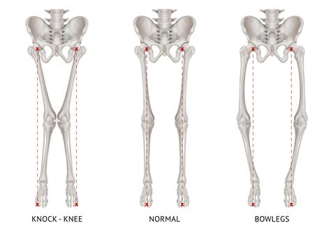 Lower Limb Malalignment Symptoms And Treatment