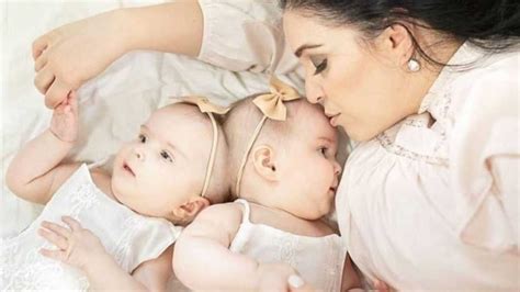 10 Month Old Twins Joined At The Skull Successfully Separated In 24