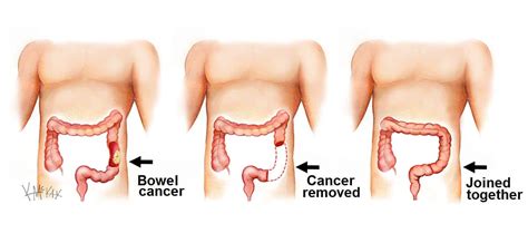 Bowel Cancer Colorectal Surgeons Sydney