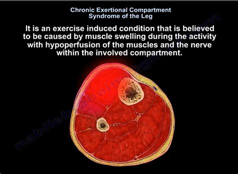 Chronic Exertional Compartment Syndrome Dr Nabil Ebraheims Blog