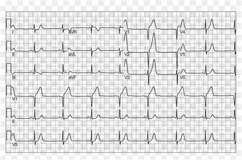 Myocardial Infarction