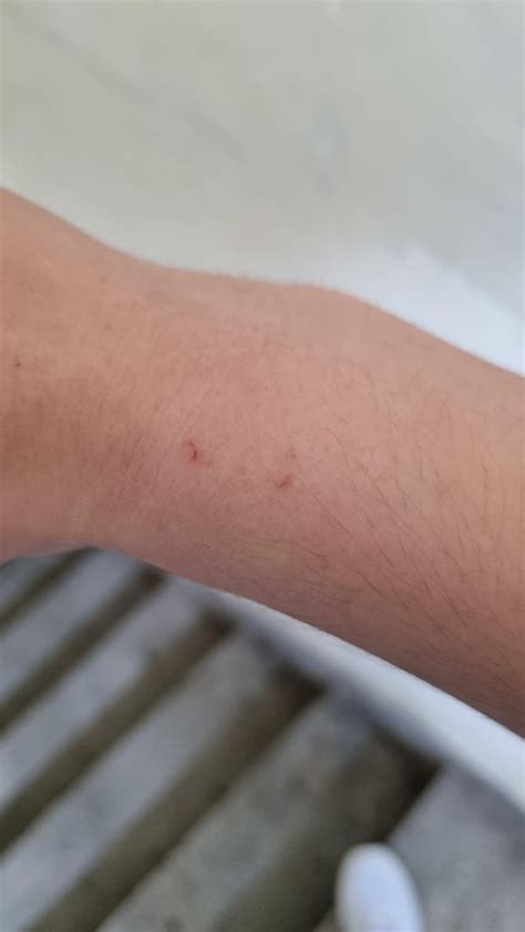 Could This Be A Bat Bite Please Respond It Doesnt Hurt Or Anything