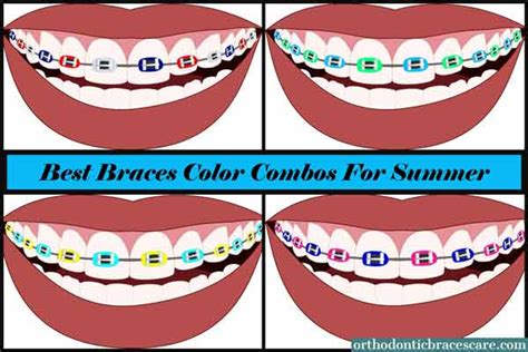 31 Unique Braces Colors And Combinations For Summer Orthodontic Braces Care