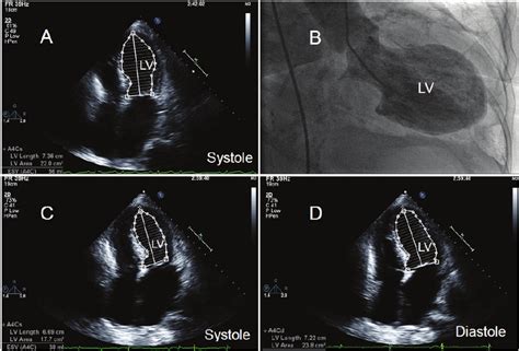 2 D Echo During Systole Upon Admission Showing Apical Akinesis And