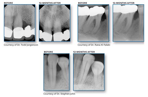 Periodontitis Treatment With Waterlase Lasers Biolase