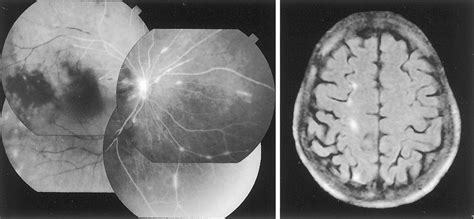 Retinal And Cerebral Artery Embolism After Shiatsu On The Neck Stroke
