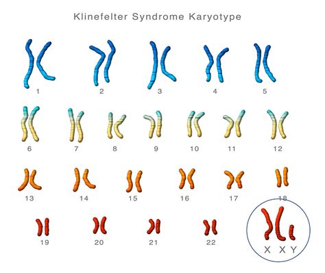 Klinefelter S Syndrome Karyotype Stock Image C Vrogue Co