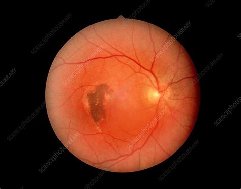 Retinopathy Showing Retinal Detachment Stock Image M1550092