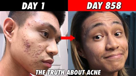 How I Cleared My Acne Youtube