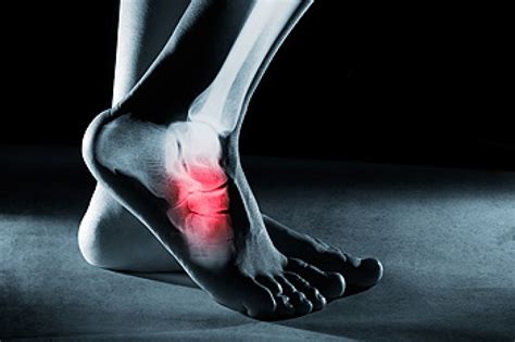Midfoot Pain Can Be Caused By Arthritis Ph