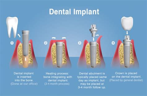 Dental Implant Placement Winchester Va Dental Implant Placement Process