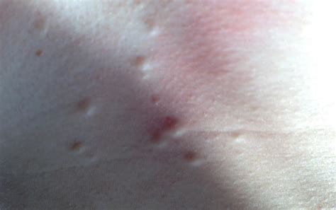 Lots Of Spots Under Skin On Chest Small Lumps What Are