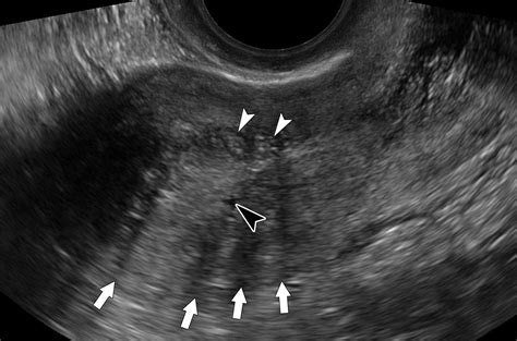 Endometrioma Ultrasound