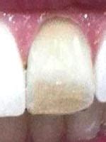 Poor dental hygiene over time can lead to bacterial decay reaching the root. Dead tooth - The life of a dead tooth - Remedy Land