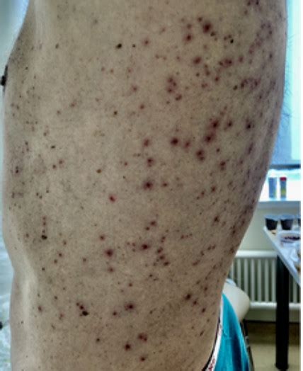 Photos Of Covid 19 Cutaneous Manifestations Dermatology Games