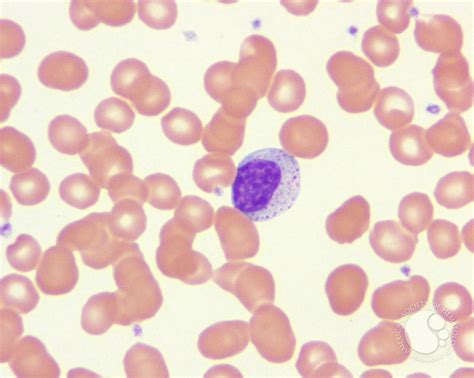 Large Granular Lymphocytes Lgls 1