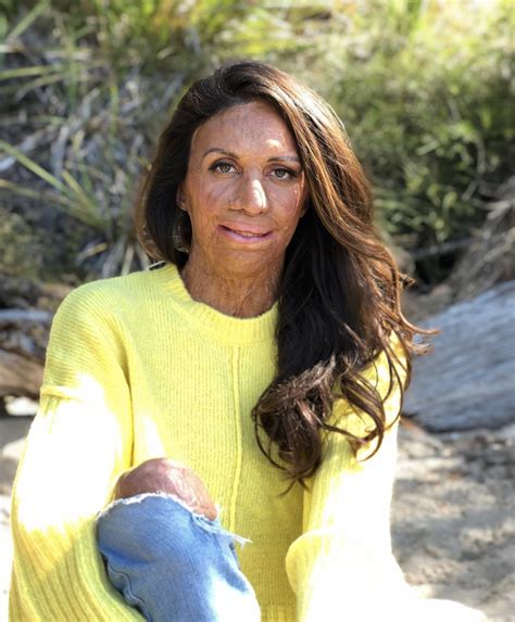 What To Say When You Don T Know What To Say Turia Pitt