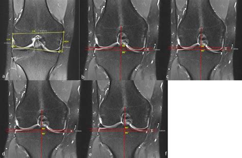 KellgrenLawrence Grade Of Osteoarthritis Is Associated With Change In