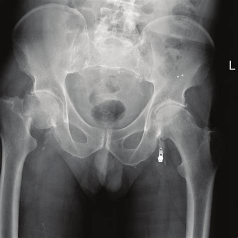 Ap Radiograph Of Pelvis Demonstrating Collapse Of Femoral Head Post