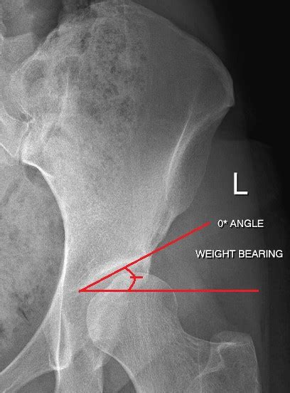 Hip Dysplasia Whats With All The Angles Miles4hips