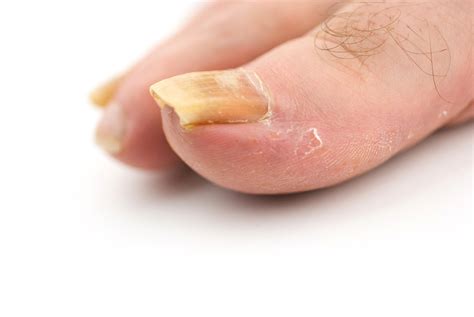 Toenail Problems Elite Podiatry