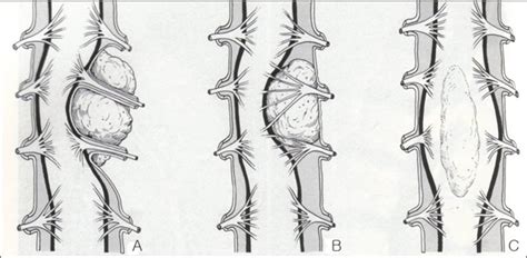 Classification Of Spinal Cord Tumor A Extradural Ed Tumor B