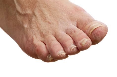 Diabetic Foot Care Marietta Foot Doctor Learn More Now