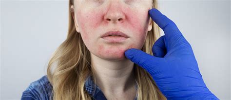 Rosacea Face The Girl Suffers From Redness On Her Cheeks Couperosis Of