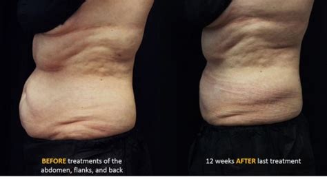 Coolsculpting ® Advanced Dermatology And Skin Surgery Advanced