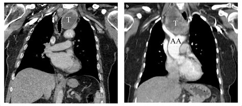 A B Computed Tomography Images Of Retrosternal Goiter Patients