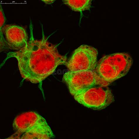 Real Fluorescence Microscopic View Of Human Neuroblastoma Cells Stock