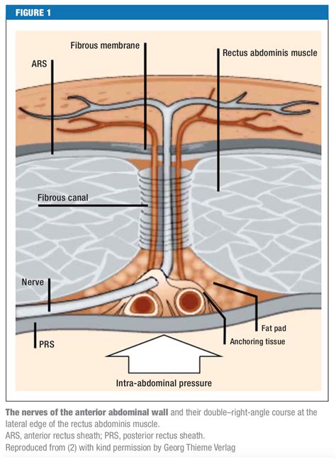 abdominal cutaneous nerve entrapment syndrome acnes core em